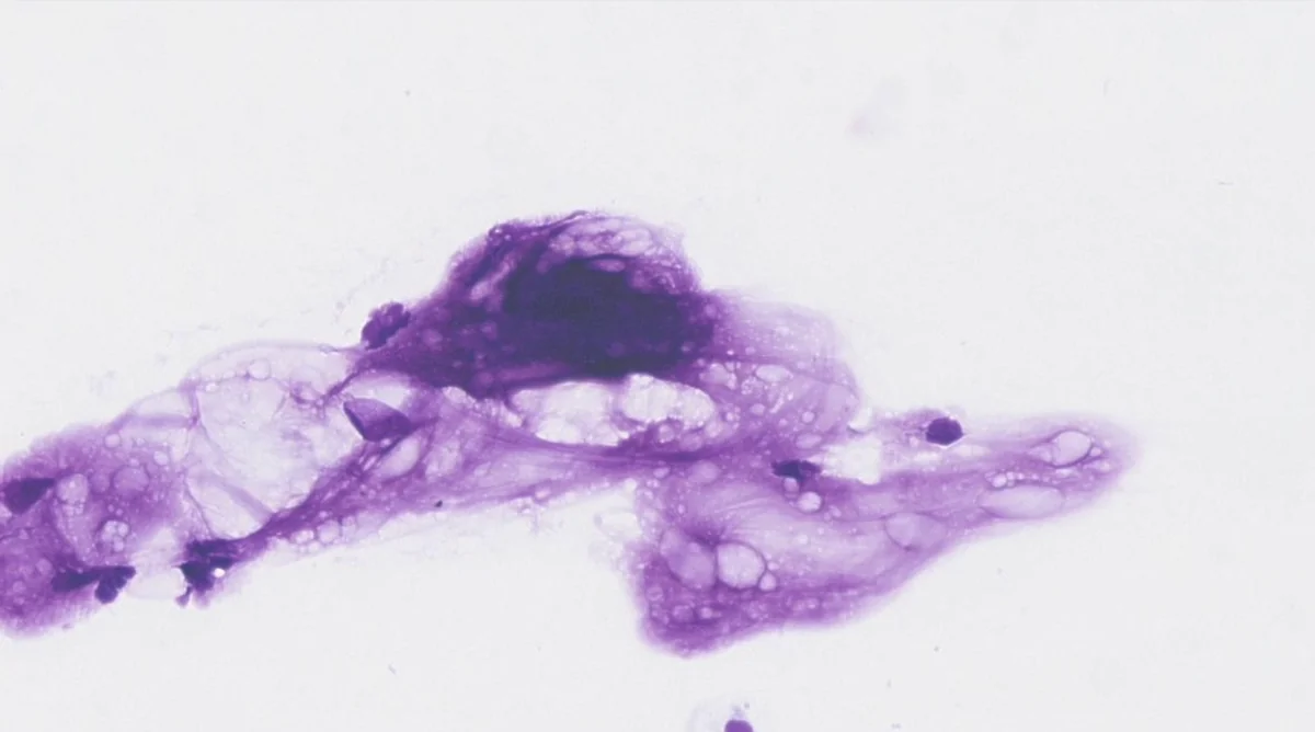 Cytologie de lipome chien - adipocytes matures et espaces graisseux dans une masse sous-cutanée