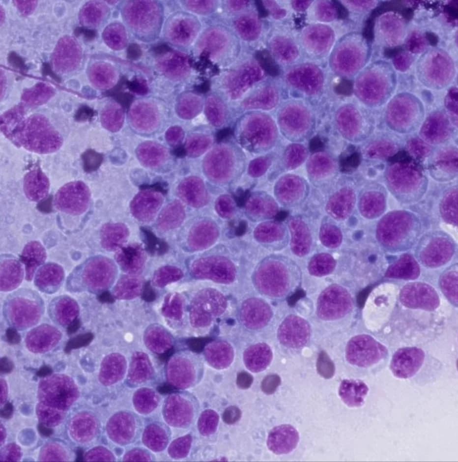 Cytologie de lymphome chien - grands lymphoblastes dans une masse cervicale, diagnostic de lymphome canin