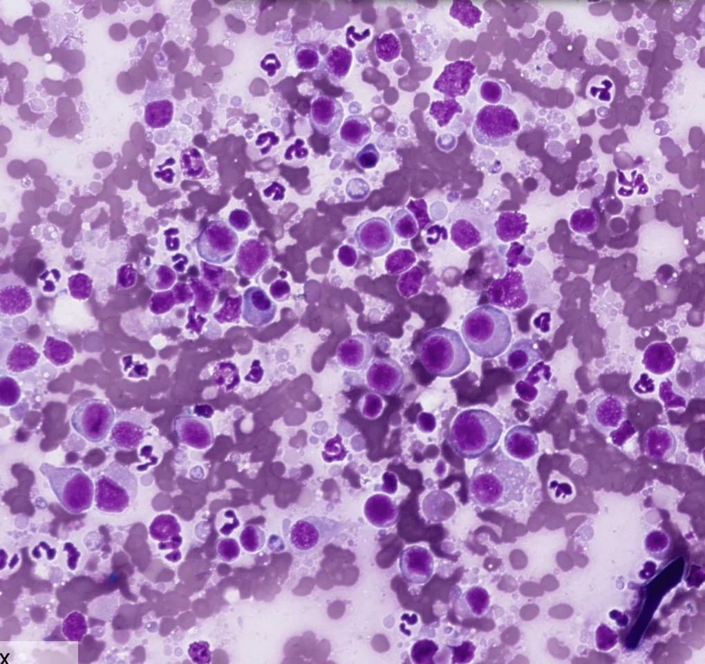Cytologie de lymphome chien - grands lymphocytes dans un prélèvement de rate hémodilué