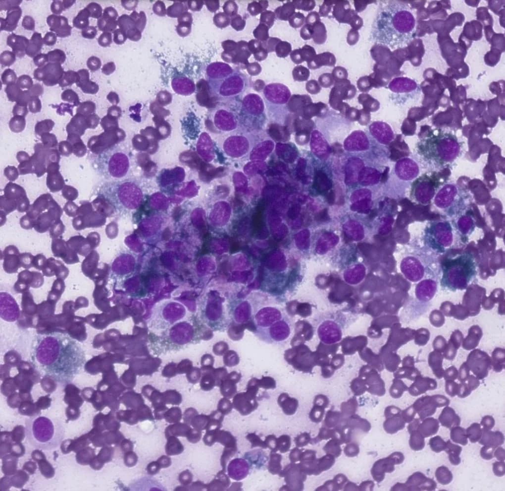 Cytologie de tumeur mélanocytaire chien - cellules pigmentées riches en mélanine dans une masse cutanée